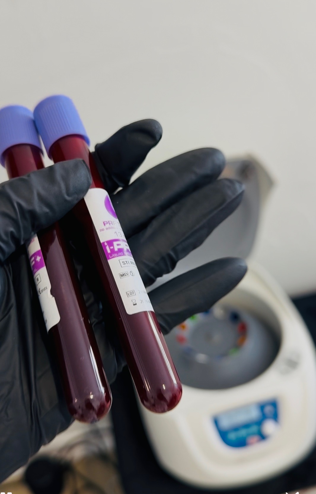 Nurse holding two collection tubes of blood